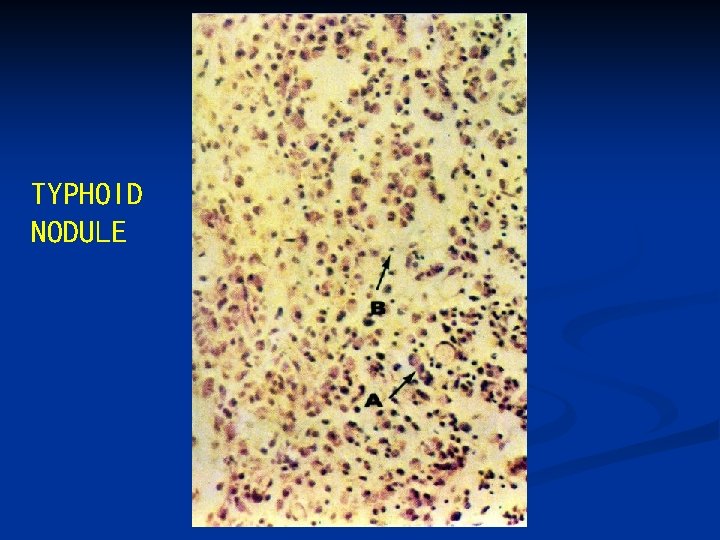 TYPHOID NODULE 