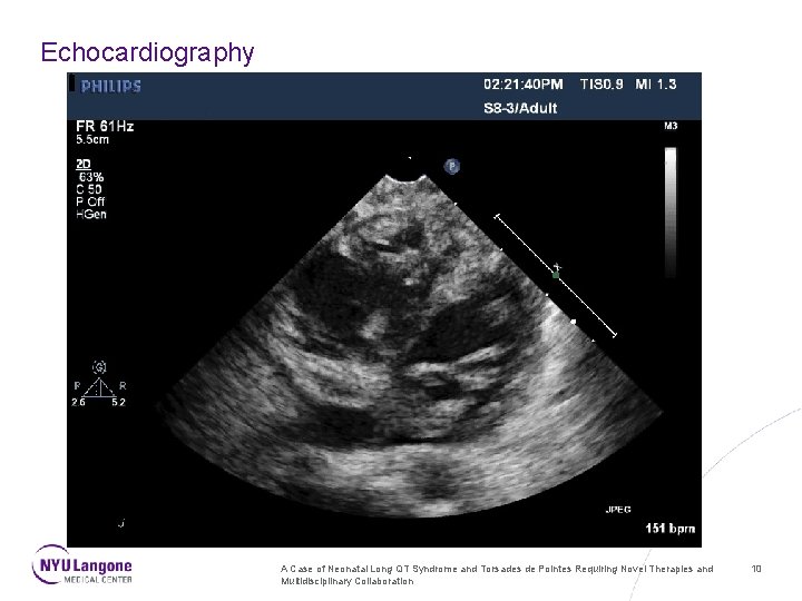 Echocardiography A Case of Neonatal Long QT Syndrome and Torsades de Pointes Requiring Novel