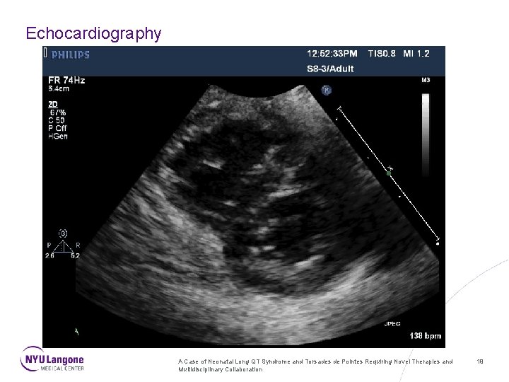 Echocardiography A Case of Neonatal Long QT Syndrome and Torsades de Pointes Requiring Novel