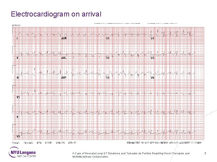 Electrocardiogram on arrival A Case of Neonatal Long QT Syndrome and Torsades de Pointes