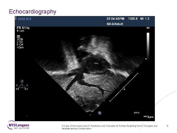 Echocardiography A Case of Neonatal Long QT Syndrome and Torsades de Pointes Requiring Novel