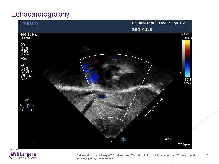 Echocardiography A Case of Neonatal Long QT Syndrome and Torsades de Pointes Requiring Novel