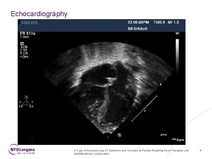 Echocardiography A Case of Neonatal Long QT Syndrome and Torsades de Pointes Requiring Novel