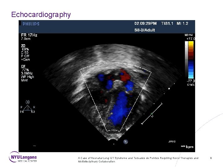 Echocardiography A Case of Neonatal Long QT Syndrome and Torsades de Pointes Requiring Novel