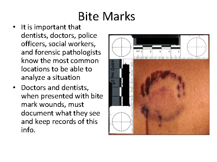 Bite Marks • It is important that dentists, doctors, police officers, social workers, and