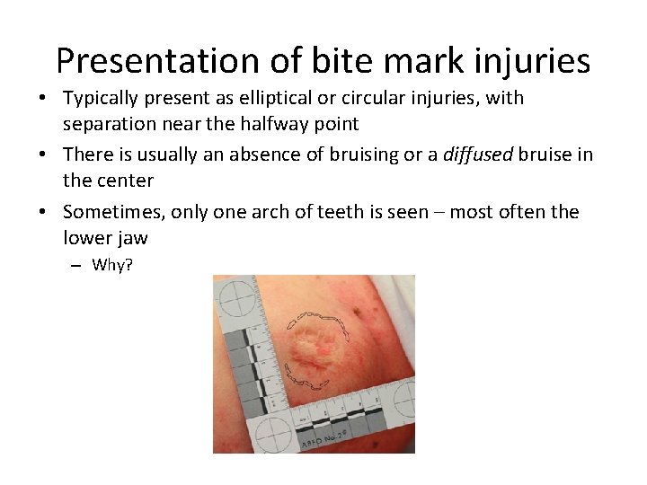 Presentation of bite mark injuries • Typically present as elliptical or circular injuries, with