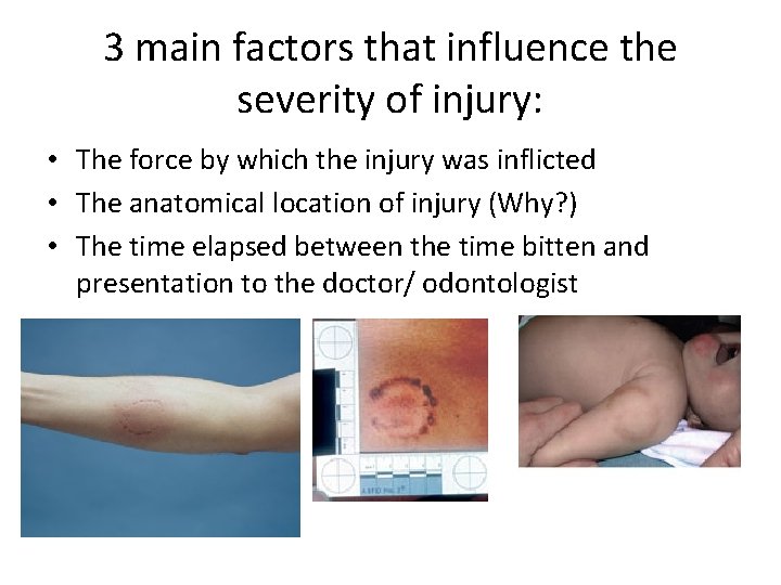 3 main factors that influence the severity of injury: • The force by which