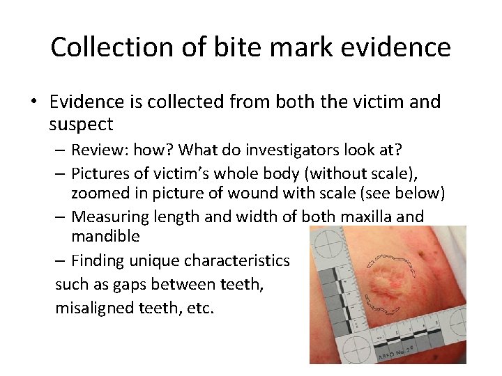 Collection of bite mark evidence • Evidence is collected from both the victim and