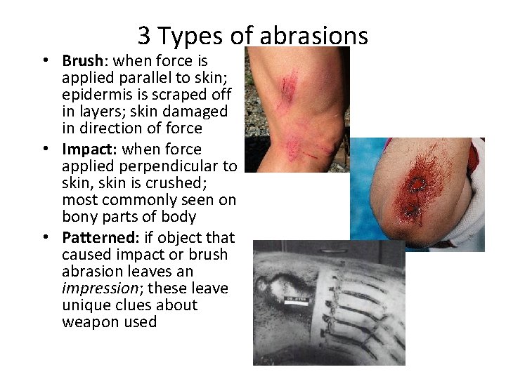 3 Types of abrasions • Brush: when force is applied parallel to skin; epidermis