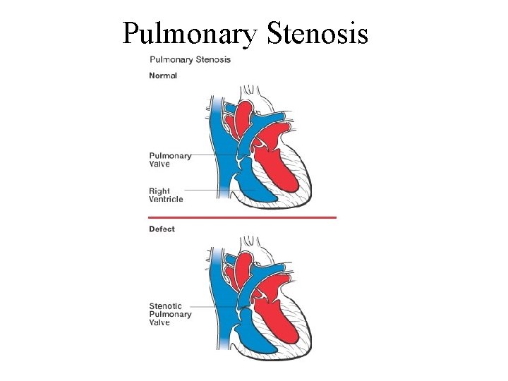 Pulmonary Stenosis 