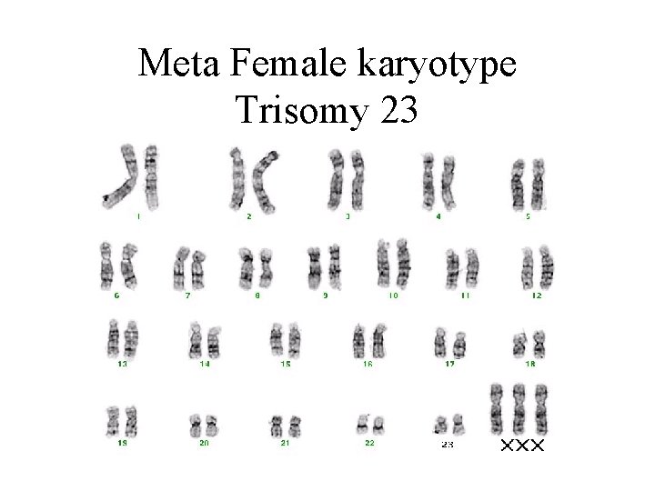 Meta Female karyotype Trisomy 23 Meta Female karyotype Trisomy 23