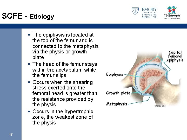 SCFE - Etiology § The epiphysis is located at the top of the femur