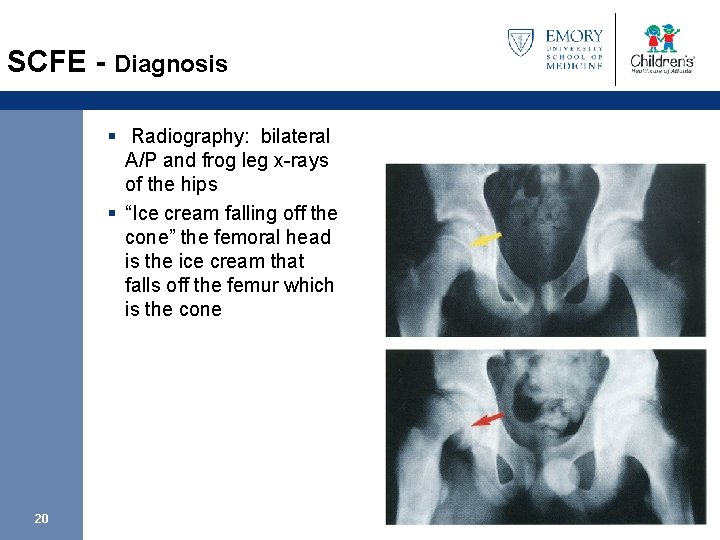 SCFE - Diagnosis § Radiography: bilateral A/P and frog leg x-rays of the hips