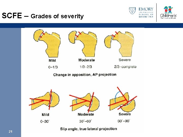 SCFE – Grades of severity 21 