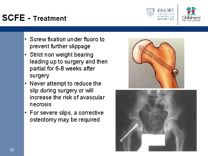 SCFE - Treatment • Screw fixation under fluoro to prevent further slippage • Strict