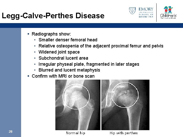 Legg-Calve-Perthes Disease § Radiographs show: • Smaller denser femoral head • Relative osteopenia of