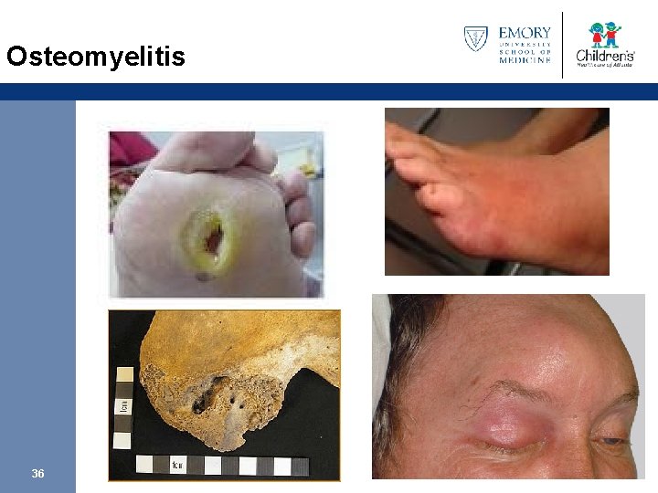 Osteomyelitis 36 