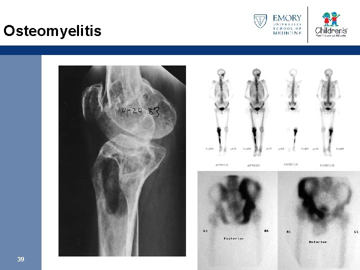 Osteomyelitis 39 