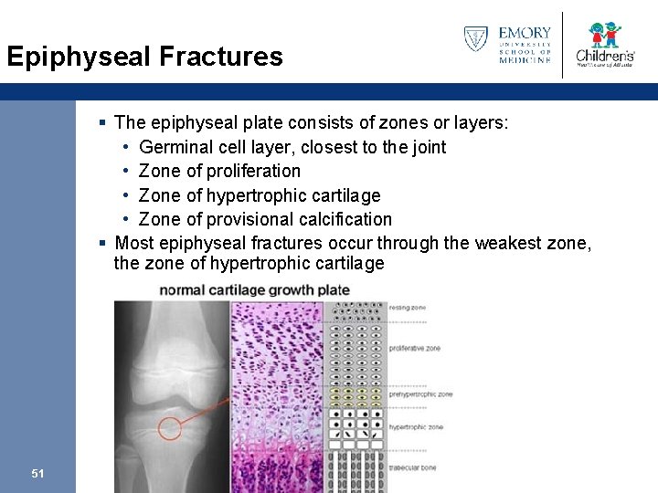 Epiphyseal Fractures § The epiphyseal plate consists of zones or layers: • Germinal cell