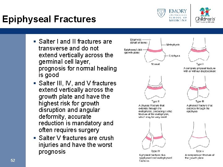 Epiphyseal Fractures § Salter I and II fractures are transverse and do not extend