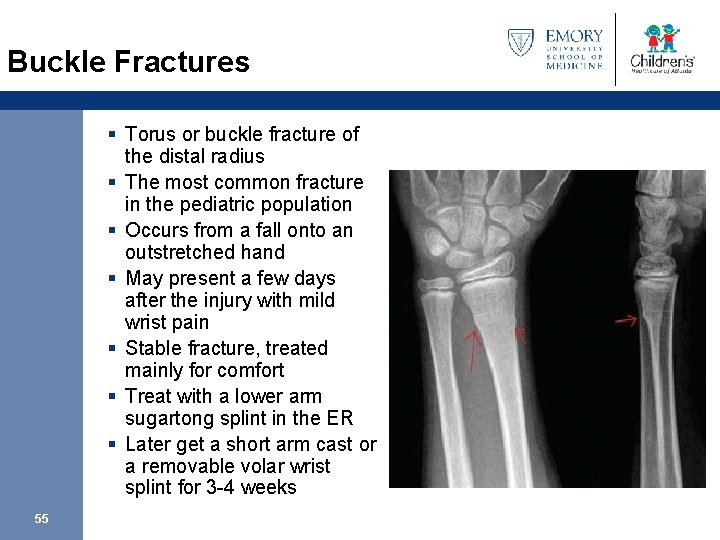 Buckle Fractures § Torus or buckle fracture of the distal radius § The most