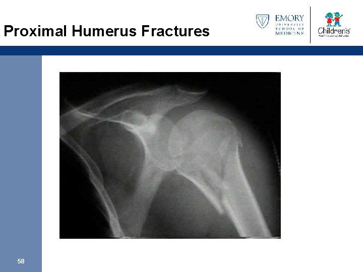 Proximal Humerus Fractures 58 