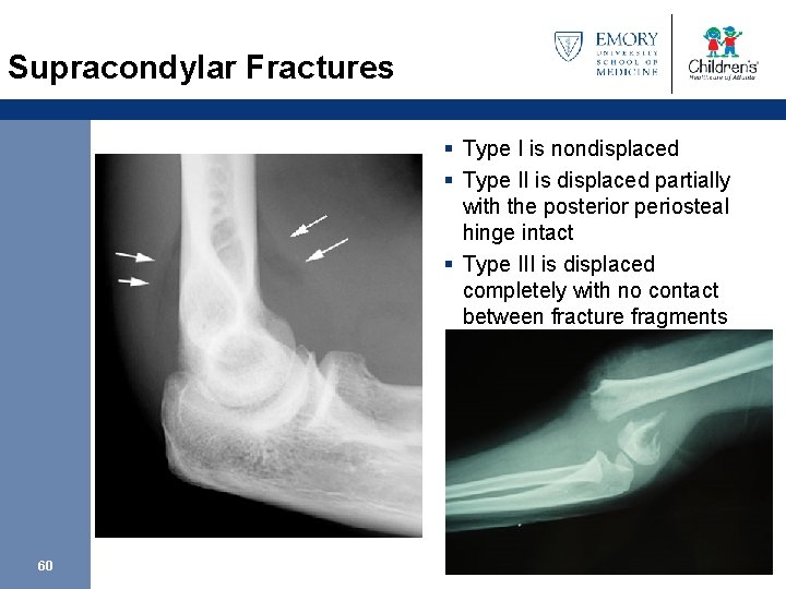 Supracondylar Fractures § Type I is nondisplaced § Type II is displaced partially with