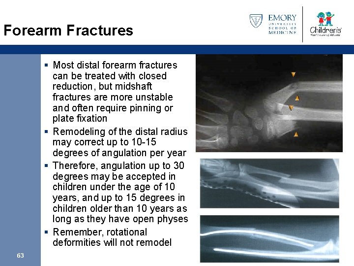 Forearm Fractures § Most distal forearm fractures can be treated with closed reduction, but
