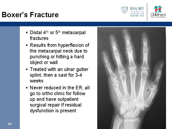 Boxer’s Fracture § Distal 4 th or 5 th metacarpal fractures § Results from