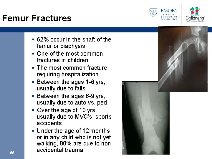 Femur Fractures 66 § 62% occur in the shaft of the femur or diaphysis