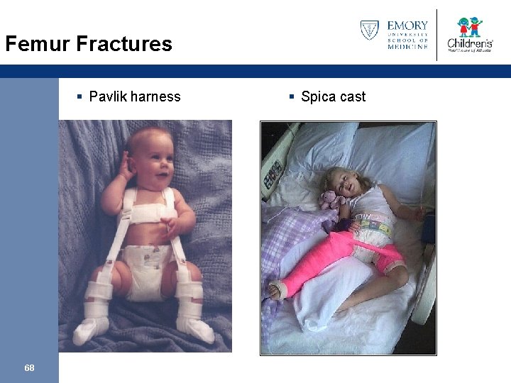 Femur Fractures § Pavlik harness 68 § Spica cast 