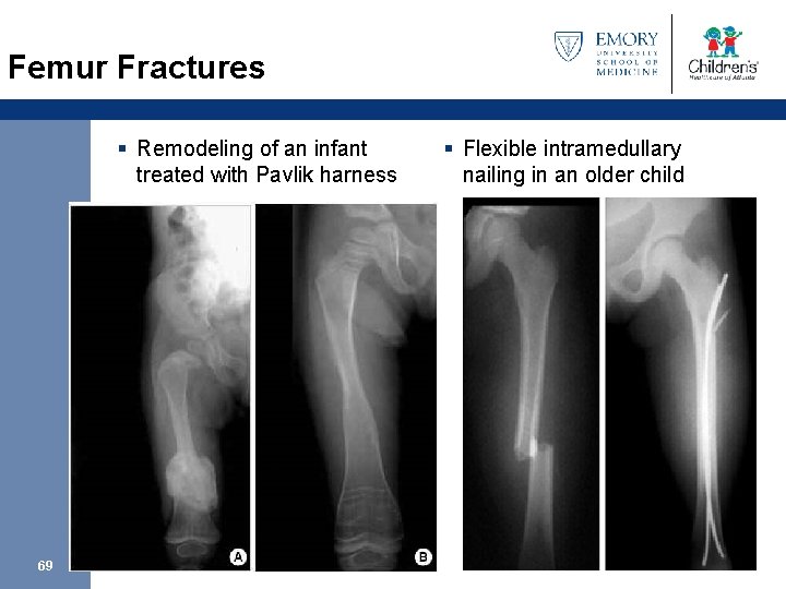 Femur Fractures § Remodeling of an infant treated with Pavlik harness 69 § Flexible