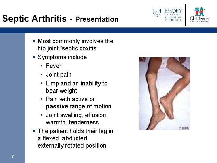 Septic Arthritis - Presentation § Most commonly involves the hip joint “septic coxitis” §