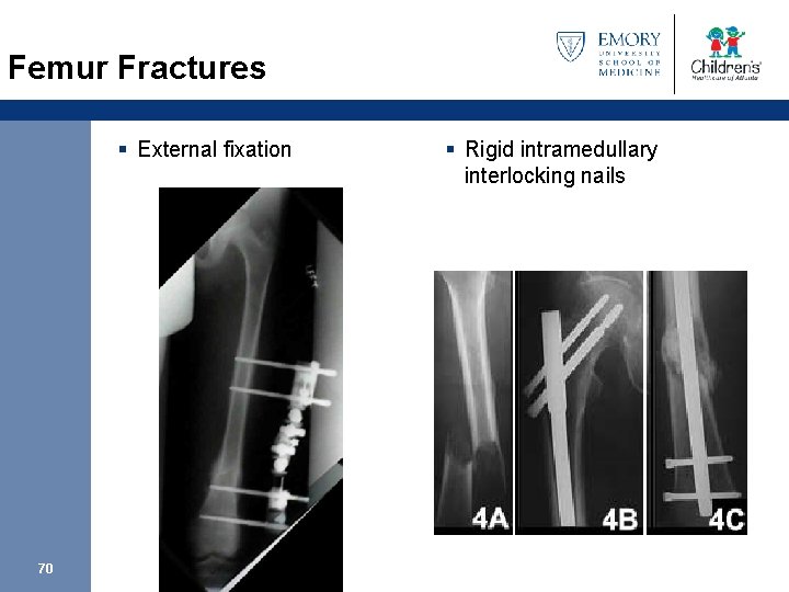 Femur Fractures § External fixation 70 § Rigid intramedullary interlocking nails 