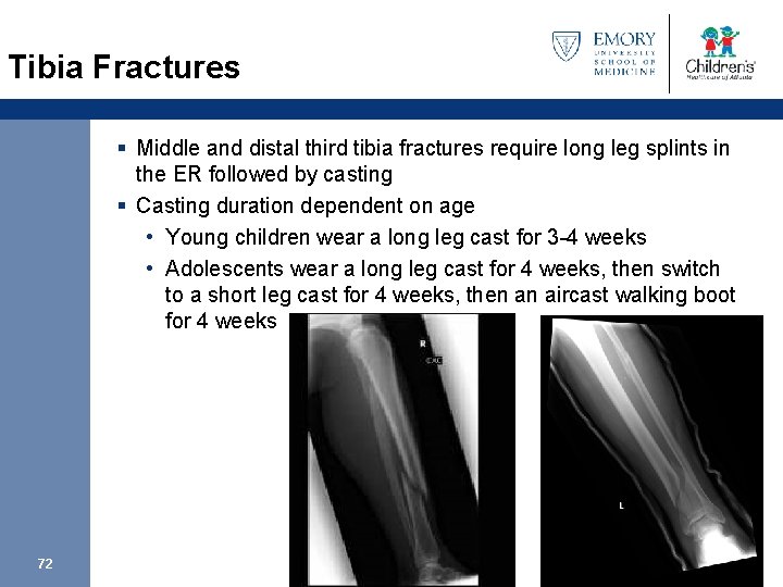 Tibia Fractures § Middle and distal third tibia fractures require long leg splints in