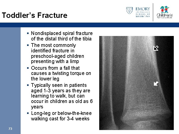 Toddler’s Fracture § Nondisplaced spiral fracture of the distal third of the tibia §