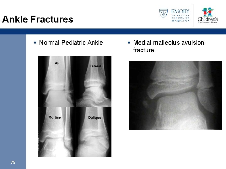 Ankle Fractures § Normal Pediatric Ankle 75 § Medial malleolus avulsion fracture 