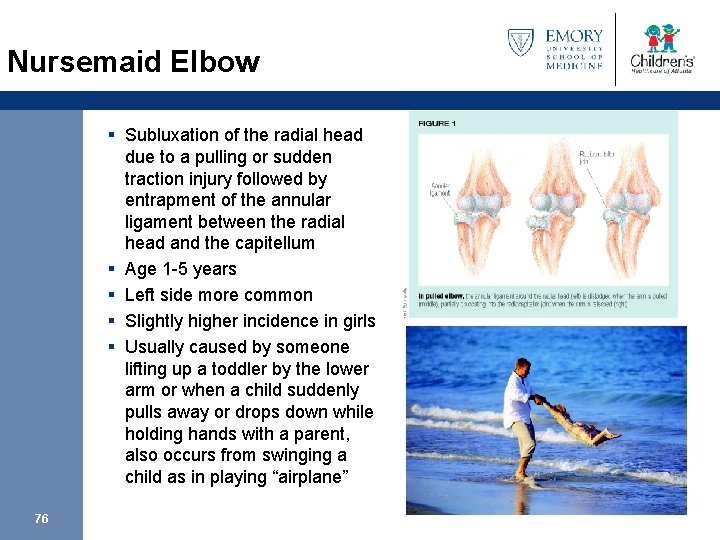 Nursemaid Elbow § Subluxation of the radial head due to a pulling or sudden