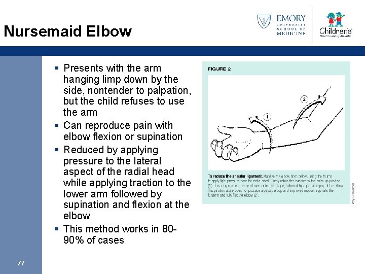 Nursemaid Elbow § Presents with the arm hanging limp down by the side, nontender