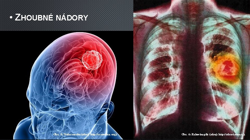 • ZHOUBNÉ NÁDORY Obr. 5: Nádor mozku (zdroj: http: //cs. medixa. org). Obr. • ZHOUBNÉ NÁDORY Obr. 5: Nádor mozku (zdroj: http: //cs. medixa. org). Obr.