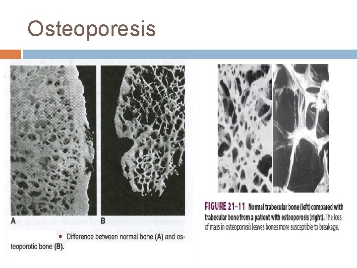 Osteoporesis 