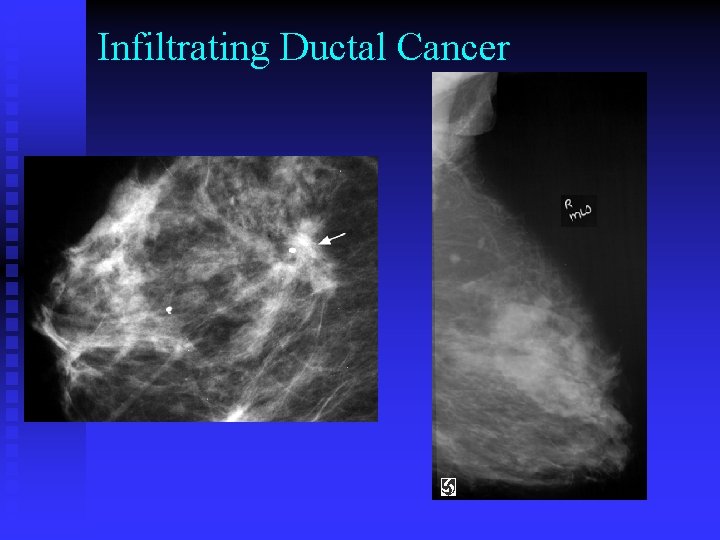 Infiltrating Ductal Cancer 