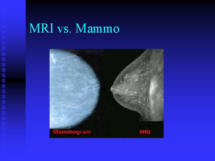 MRI vs. Mammo 