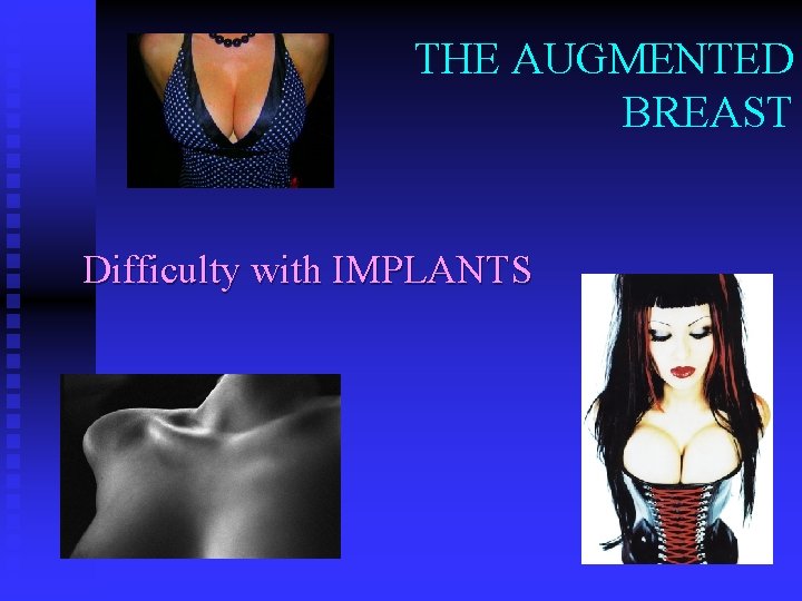 THE AUGMENTED BREAST Difficulty with IMPLANTS 