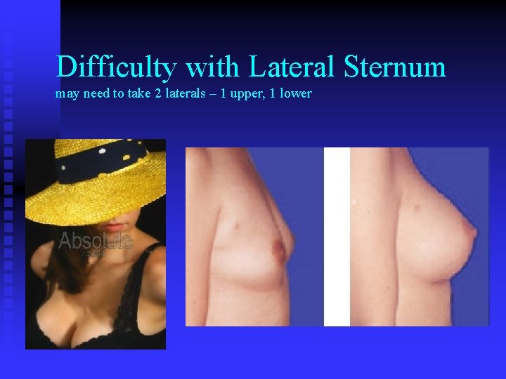 Difficulty with Lateral Sternum may need to take 2 laterals – 1 upper, 1