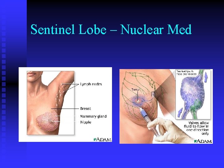 Sentinel Lobe – Nuclear Med 