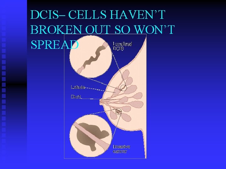 DCIS– CELLS HAVEN’T BROKEN OUT SO WON’T SPREAD 