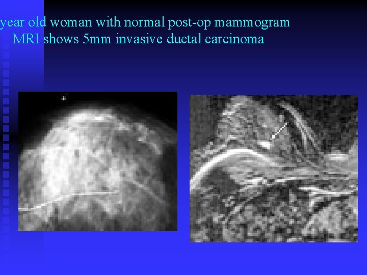  year old woman with normal post-op mammogram MRI shows 5 mm invasive ductal