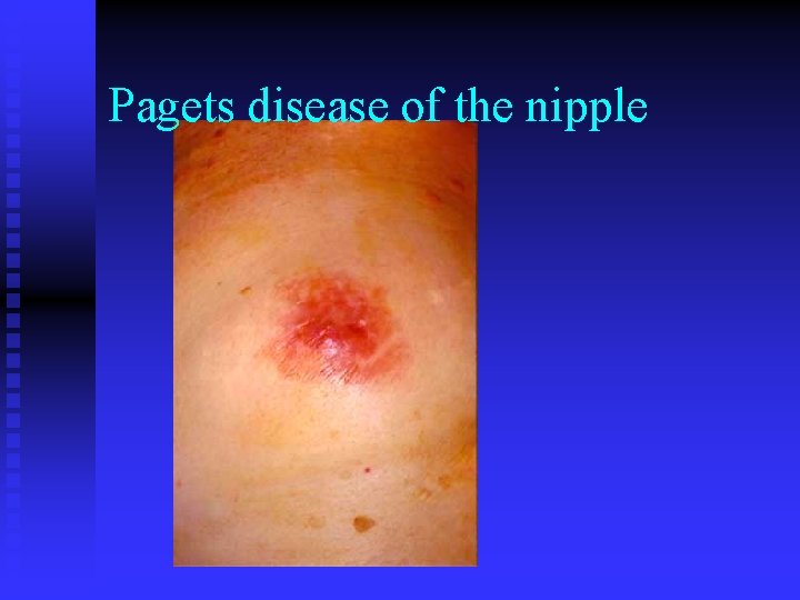 Pagets disease of the nipple 