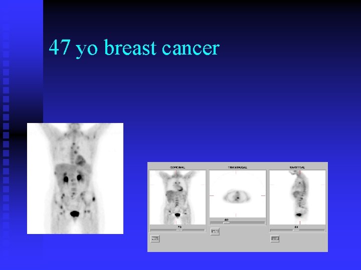 47 yo breast cancer 